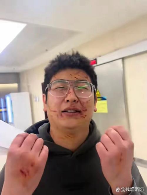 字母哥谈眼部淤青：逛超市遇到个男的抢劫 制服他的过程中被打到